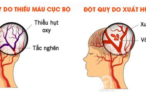 DẤU HIỆU ĐỘT QUỴ CẤP – NHẬN BIẾT NHANH THEO NGUYÊN TẮC FAST