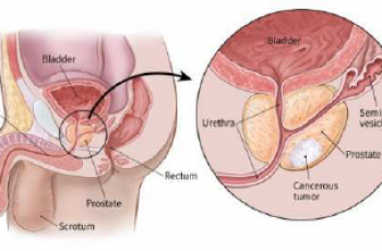 PSA, PC (Prostate Cancer = Ung Thư Tiền Liệt Tuyến) & Tranh Luận  về Screening, Diagnosis, Treatment