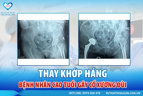 THAY KHỚP HÁNG CHO BỆNH NHÂN CAO TUỔI BỊ GÃY CỔ XƯƠNG ĐÙI