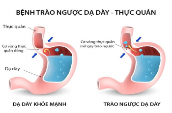 TRÀO NGƯỢC DẠ DÀY - THỰC QUẢN: DẤU HIỆU Ợ NÓNG VÀ KHI NÀO CẦN NỘI SOI KIỂM TRA?