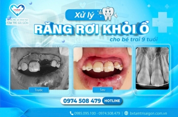XỬ LÝ RĂNG RƠI KHỎI Ổ CHO BÉ TRAI 9 TUỔI 