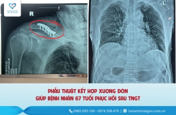 PHẪU THUẬT KẾT HỢP XƯƠNG ĐÒN GIÚP BỆNH NHÂN 67 TUỔI HỒI PHỤC SAU TAI NẠN GIAO THÔNG