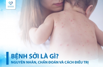 BỆNH SỞI LÀ GÌ? NGUYÊN NHÂN, TRIỆU CHỨNG, CHẨN ĐOÁN VÀ CÁCH ĐIỀU TRỊ