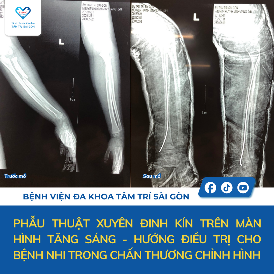 So sánh trước và sau mổ