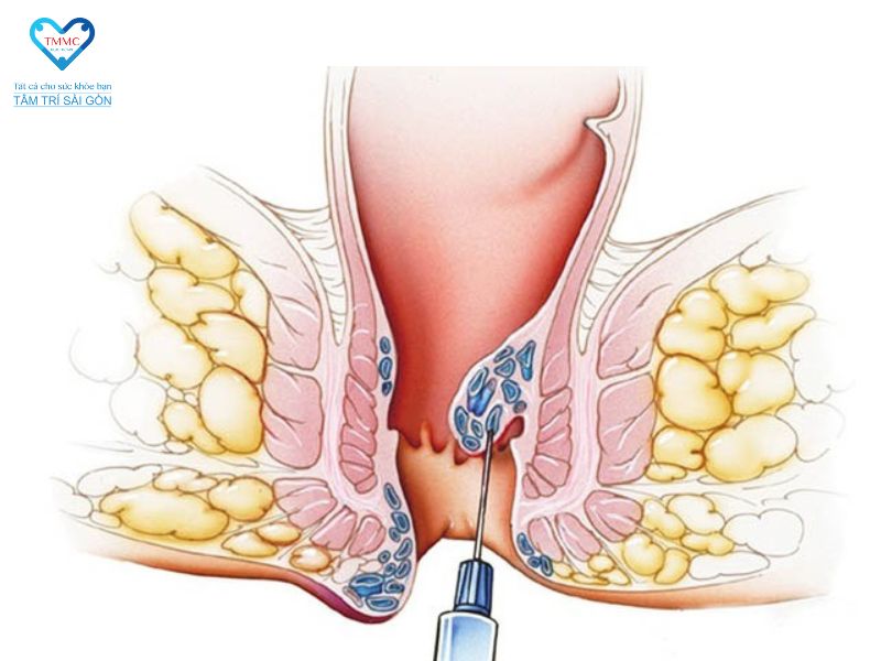 Phương pháp điều trị bệnh trĩ mới nhất cho mức độ nhẹ