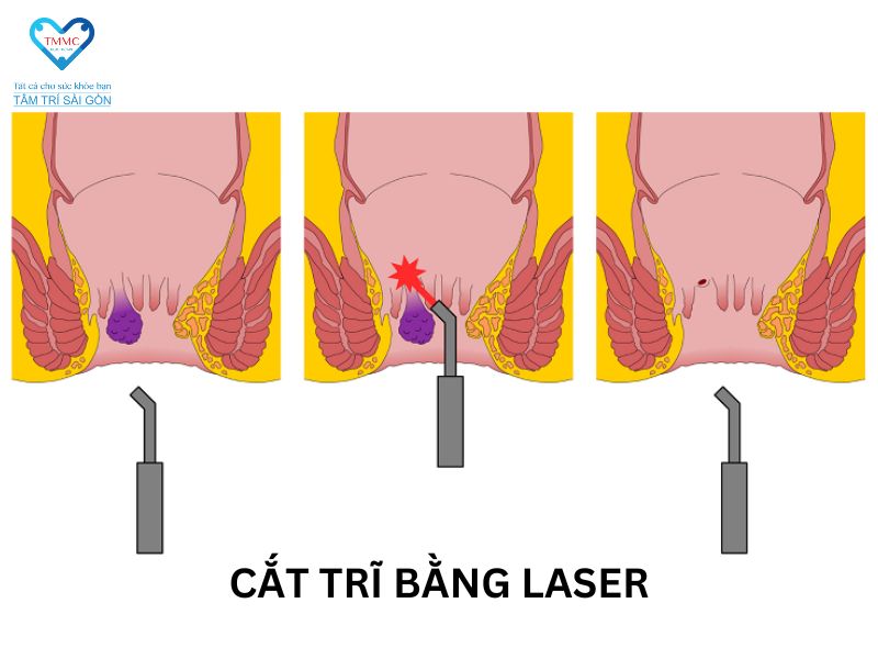 Cách chữa bệnh trĩ bằng cắt laser