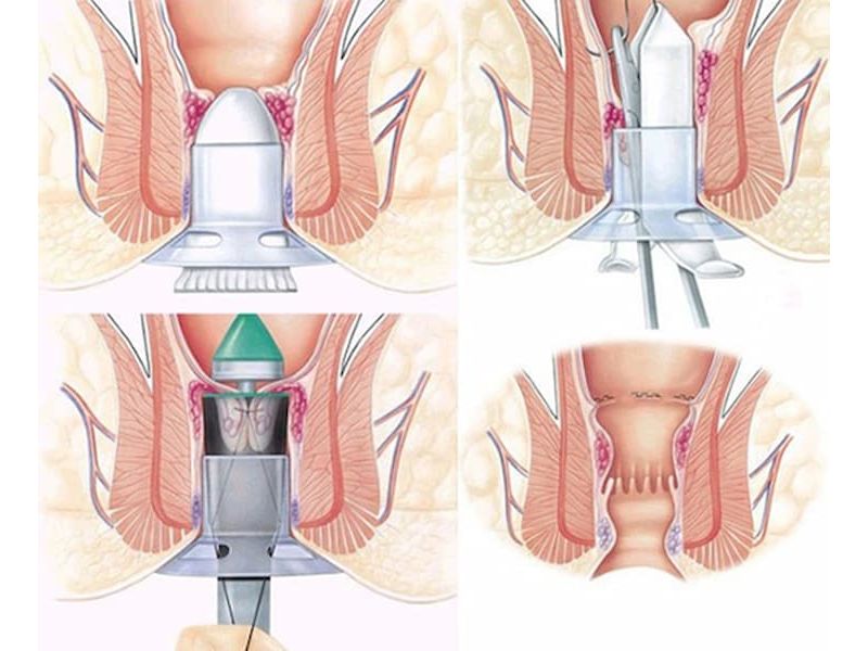 Phẫu thuật Longo phương pháp điều trị bệnh trĩ mới nhất