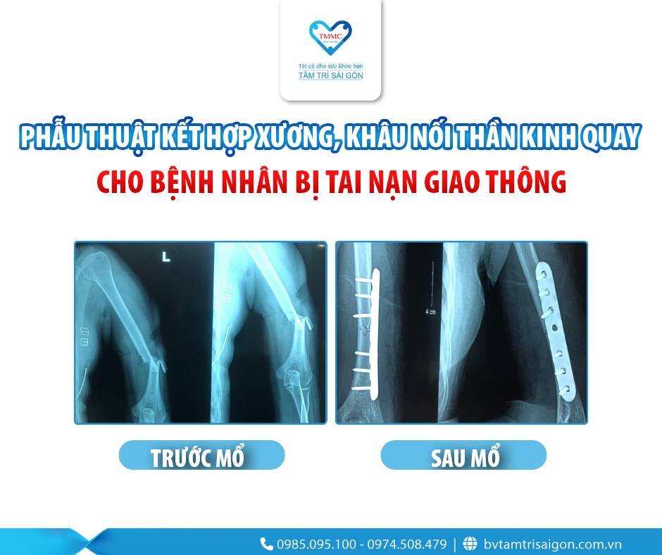 Phau_thuat_ket_hop_xuong_khau_noi_than_kinh_quay_1