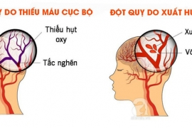 DẤU HIỆU ĐỘT QUỴ CẤP – NHẬN BIẾT NHANH THEO NGUYÊN TẮC FAST