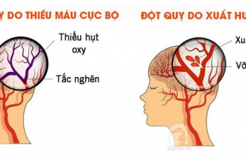 DẤU HIỆU ĐỘT QUỴ CẤP – NHẬN BIẾT NHANH THEO NGUYÊN TẮC FAST