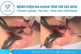 CẬN CẢNH CẮT THẮNG LƯỠI Ở TRẺ EM – THỦ THUẬT NHỎ, HIỆU QUẢ LỚN!
