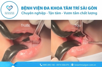 CẬN CẢNH CẮT THẮNG LƯỠI Ở TRẺ EM – THỦ THUẬT NHỎ, HIỆU QUẢ LỚN!