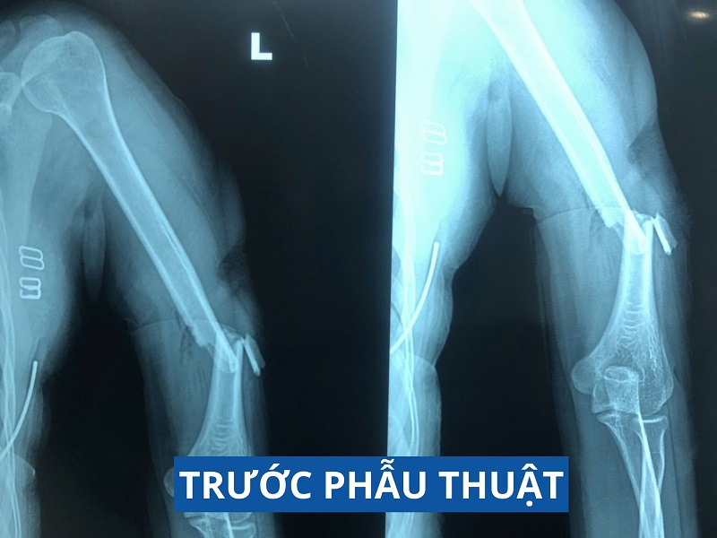 Trường hợp phẫu thuật nối dây thần kinh phức tạp đã được Bệnh viện đa khoa Tâm Trí Sài Gòn đưa tin vào ngày 21.1.2024