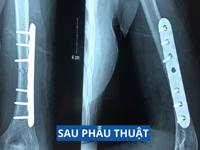 Trường hợp phẫu thuật nối dây thần kinh phức tạp đã được Bệnh viện đa khoa Tâm Trí Sài Gòn đưa tin vào ngày 21.1.2024