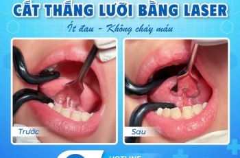 DÍNH THẮNG LƯỠI Ở TRẺ NHỎ – CÓ NÊN CẮT KHÔNG?