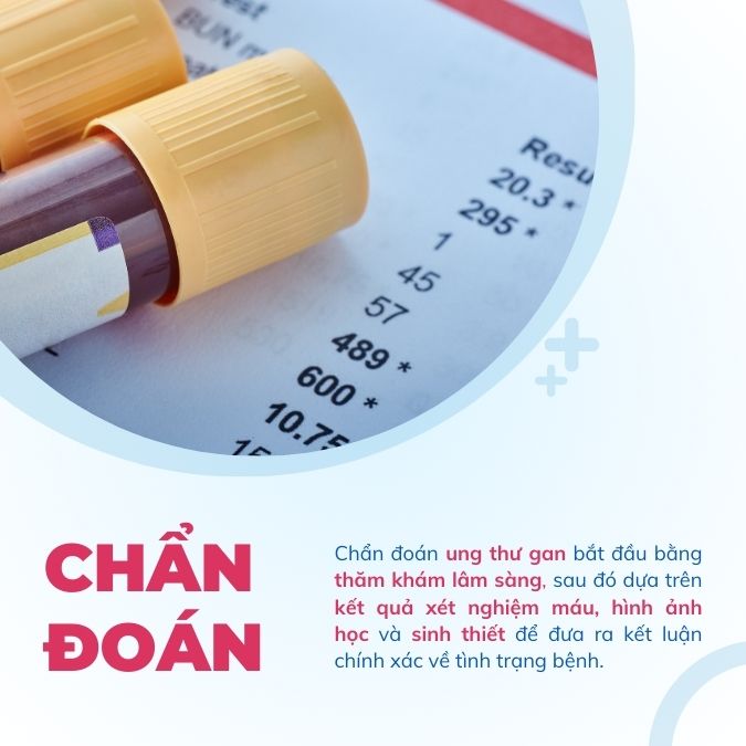 Chẩn đoán ung thư gan