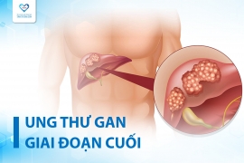 UNG THƯ GAN GIAI ĐOẠN CUỐI: TIÊN LƯỢNG SỐNG, TRIỆU CHỨNG VÀ ĐIỀU TRỊ GIẢM NHẸ