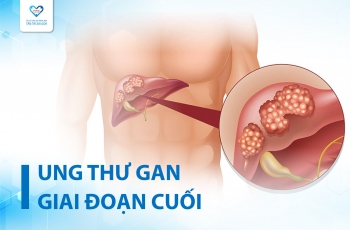 UNG THƯ GAN GIAI ĐOẠN CUỐI: TIÊN LƯỢNG SỐNG, TRIỆU CHỨNG VÀ ĐIỀU TRỊ GIẢM NHẸ