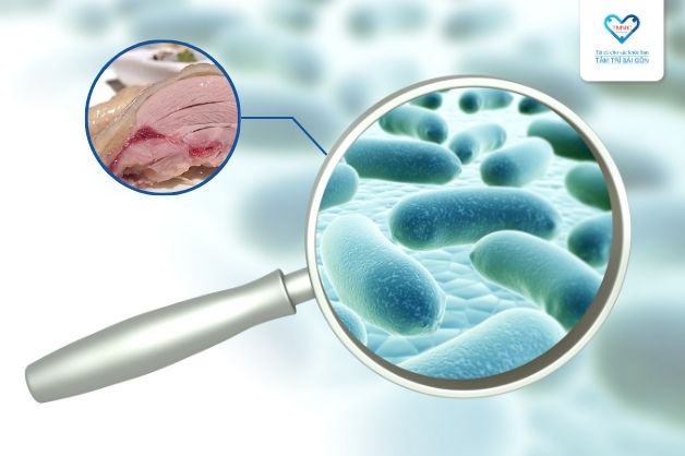 Viêm dạ dày do nhiễm khuẩn H.pylori