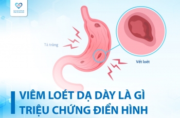 VIÊM LOÉT DẠ DÀY LÀ GÌ? CÁC TRIỆU CHỨNG VIÊM LOÉT DẠ DÀY ĐIỂN HÌNH