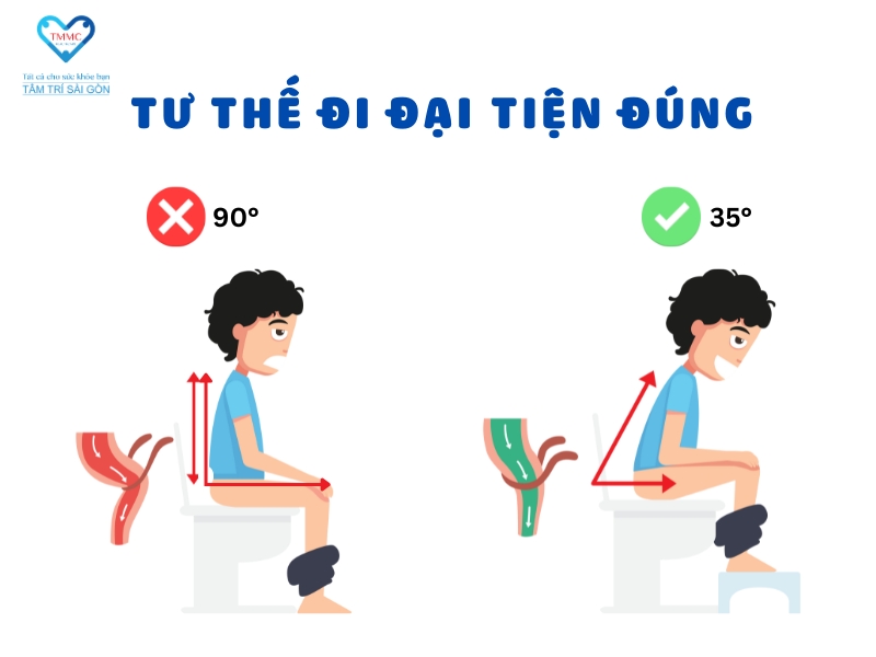 Cách trị táo bón bằng việc điều chỉnh tư thế đại tiện