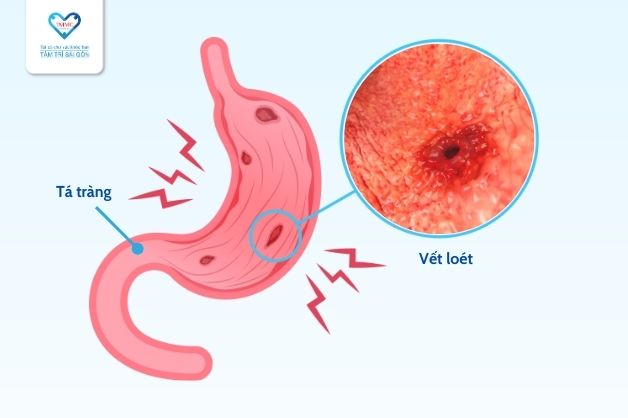 Viêm loét dạ dày là gì