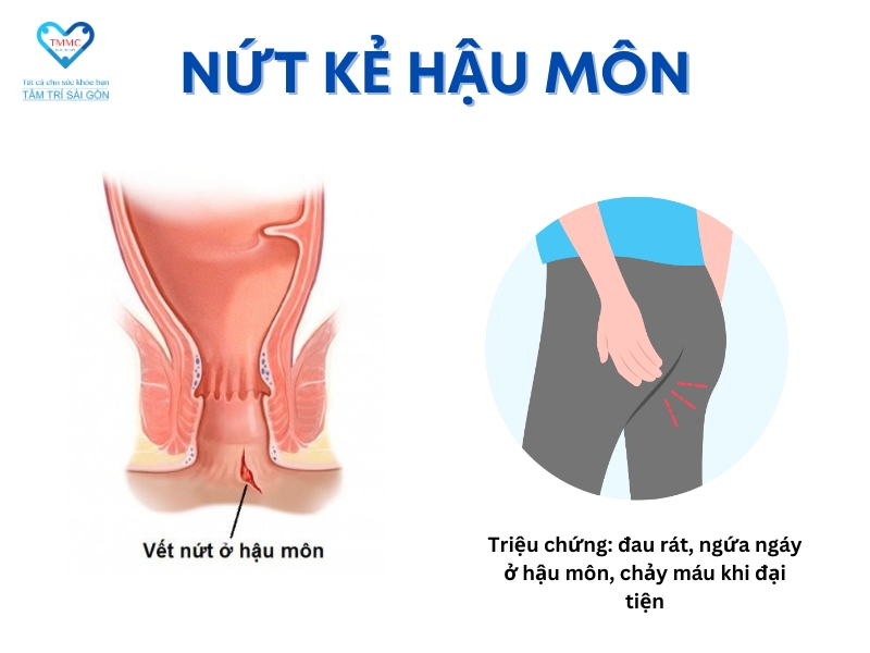 Bệnh nứt kẽ hậu môn là gì