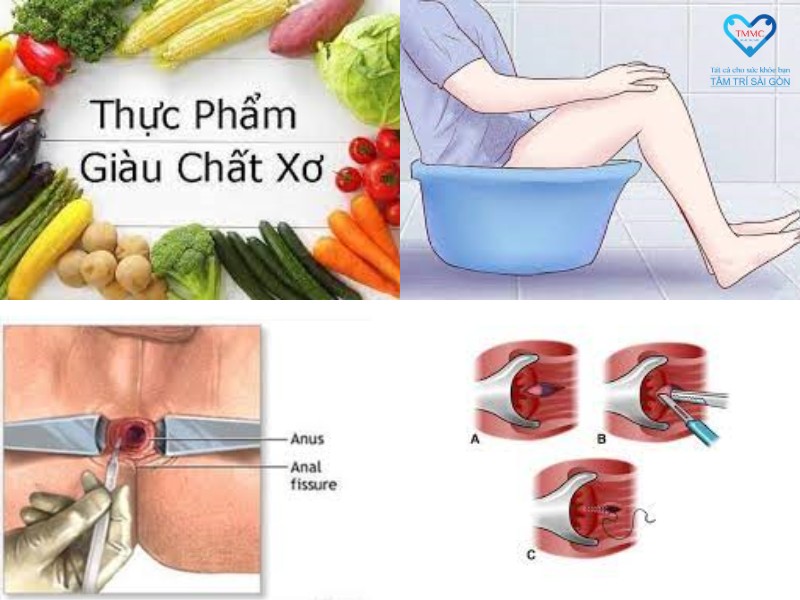 Cách điều trị nứt kẽ hậu môn