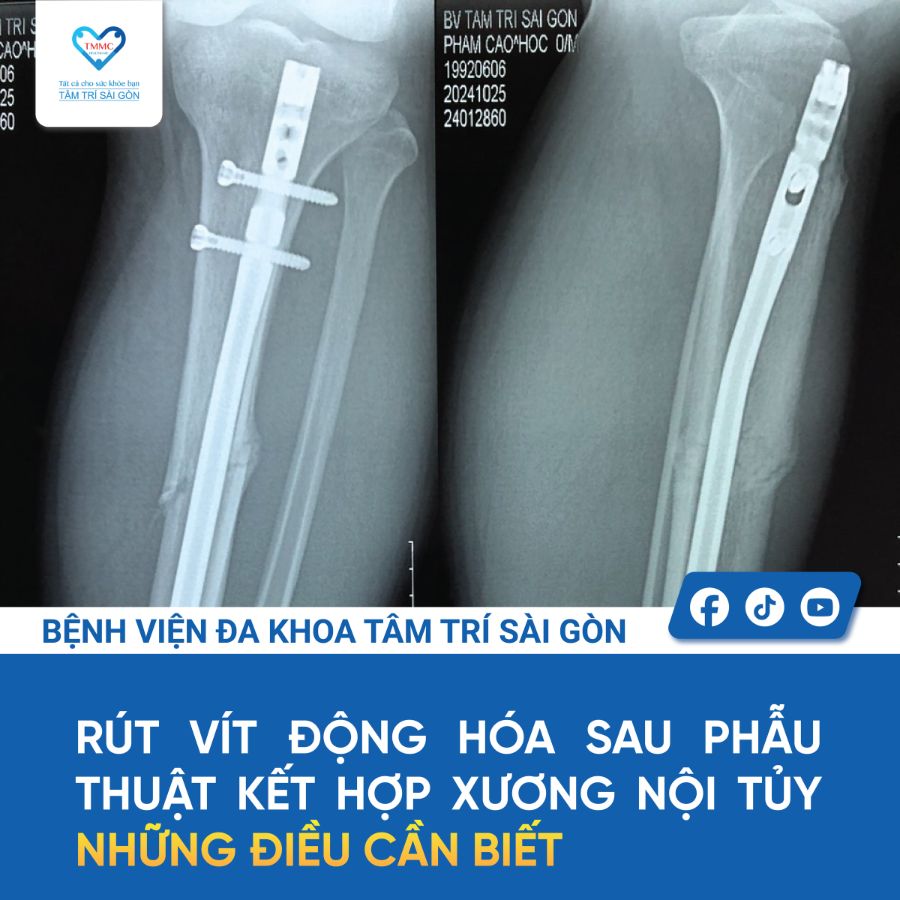 Rút vít động hóa sau phẫu thuật