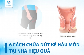 6 CÁCH CHỮA NỨT KẼ HẬU MÔN TẠI NHÀ HIỆU QUẢ