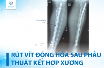 RÚT VÍT ĐỘNG HÓA SAU PHẪU THUẬT KẾT HỢP XƯƠNG NỘI TỦY - NHỮNG ĐIỀU CẦN BIẾT