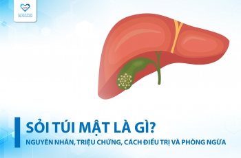 SỎI TÚI MẬT LÀ GÌ? NGUYÊN NHÂN, TRIỆU CHỨNG, CÁCH ĐIỀU TRỊ VÀ PHÒNG NGỪA