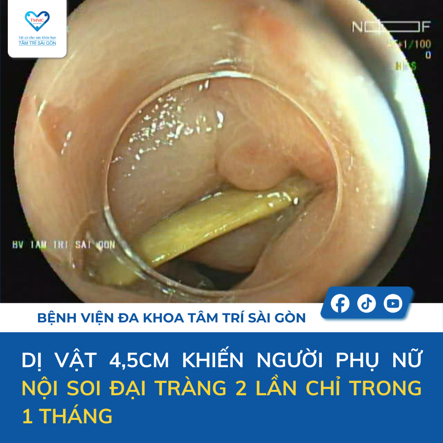 Hình ảnh nội soi đại tràng bệnh nhân