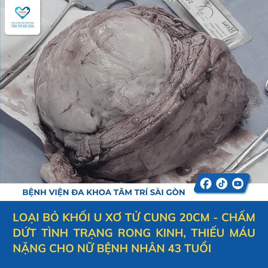 Mổ u xơ tử cung