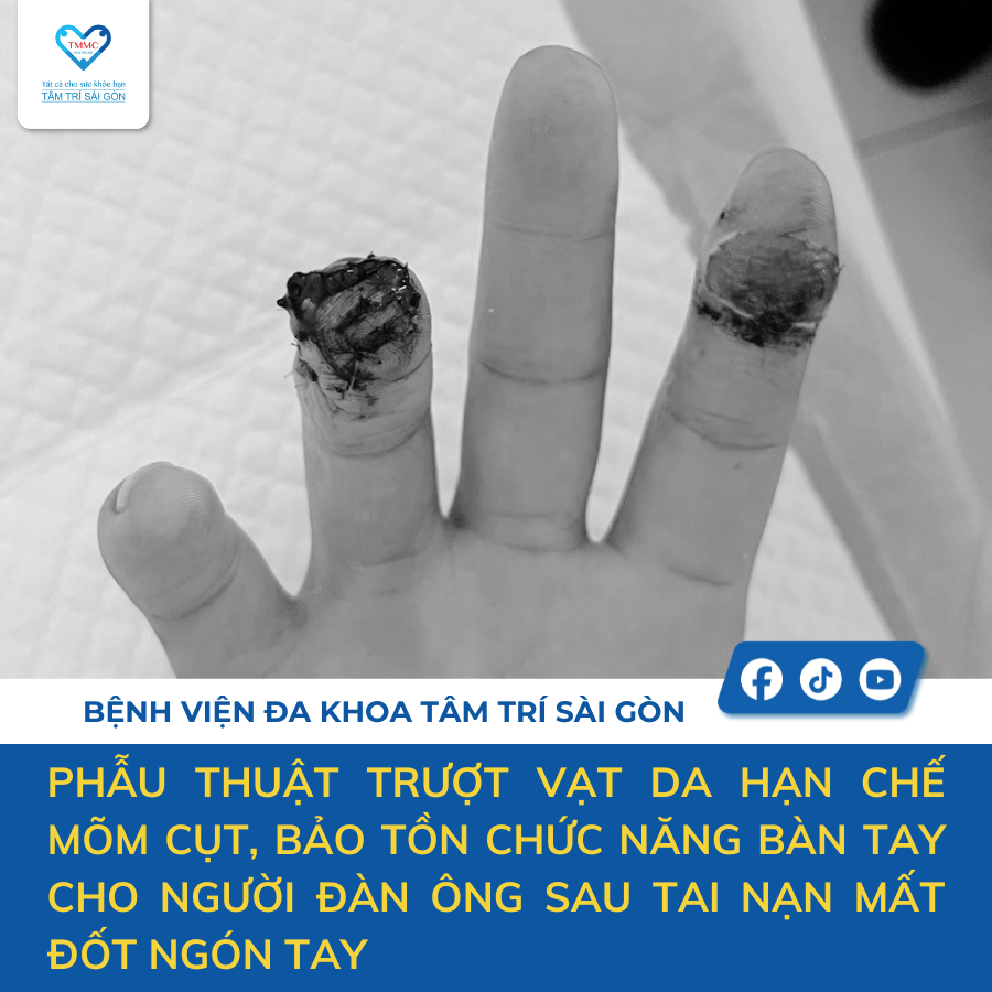 Phẫu thuật trượt vạt da