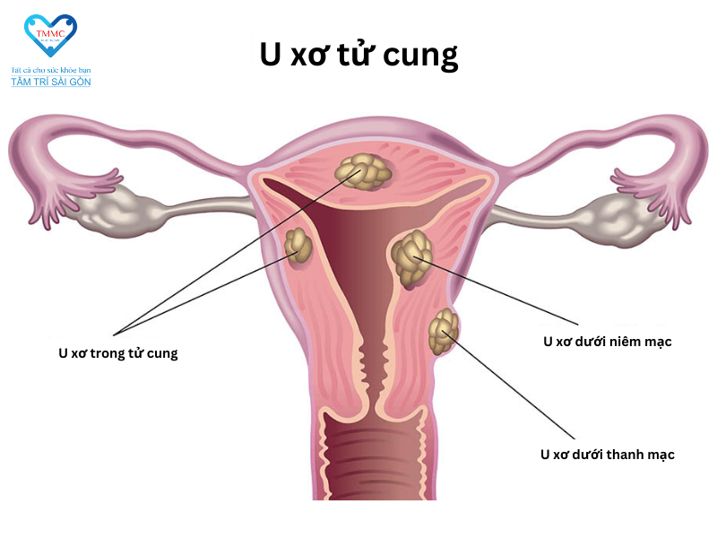 U xơ tử cung là gì