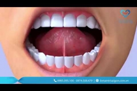 DÍNH THẮNG LƯỠI Ở TRẺ – PHÁT HIỆN SỚM, CAN THIỆP NHANH